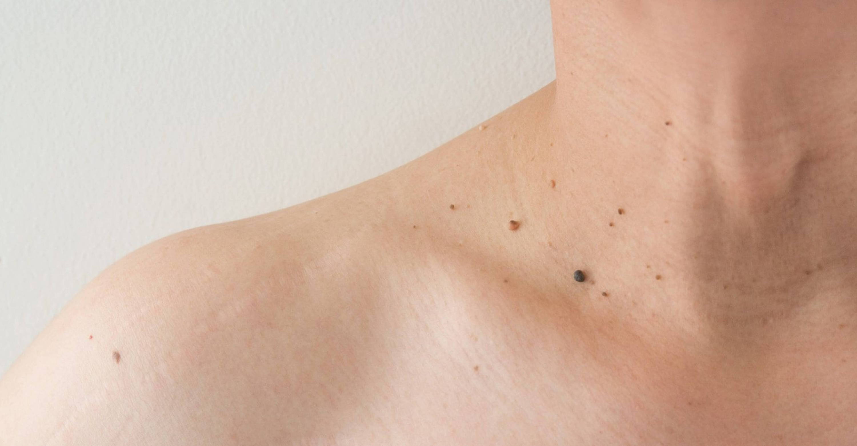Skin Tags Medical Guide Should You Get Surgery? Skintify